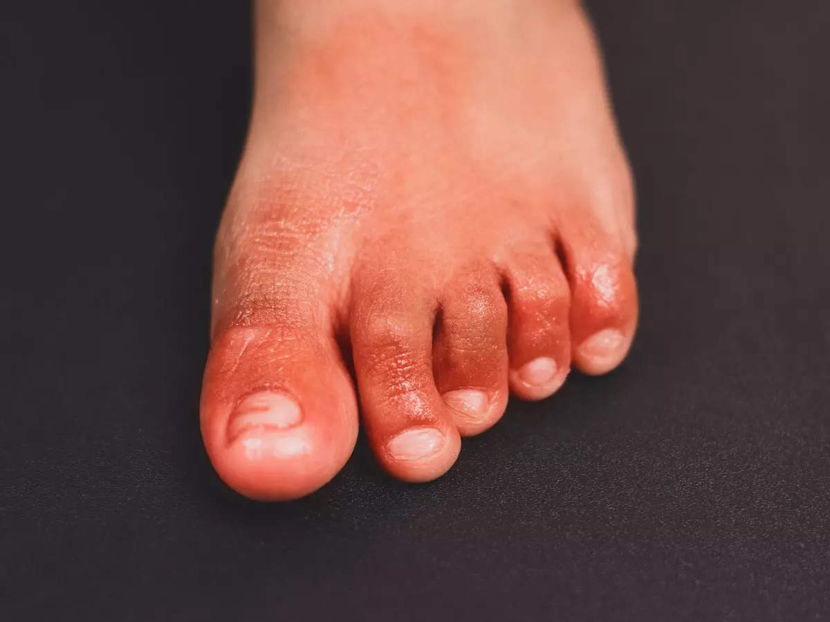 from-hairy-tongue-to-covid-toe-5-unusual-covid-symptoms-the-times-of