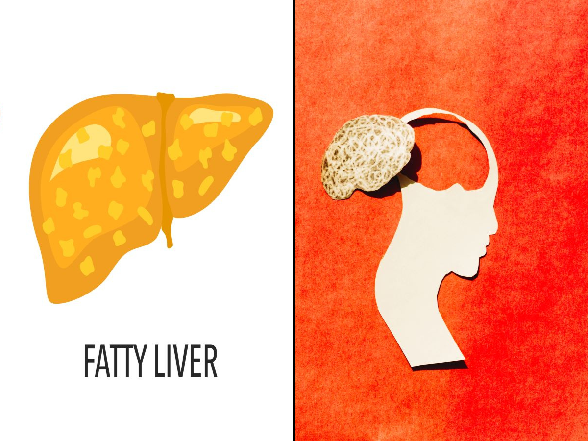 fatty-liver-from-eating-too-much-sugar-and-fat-linked-to-neurological