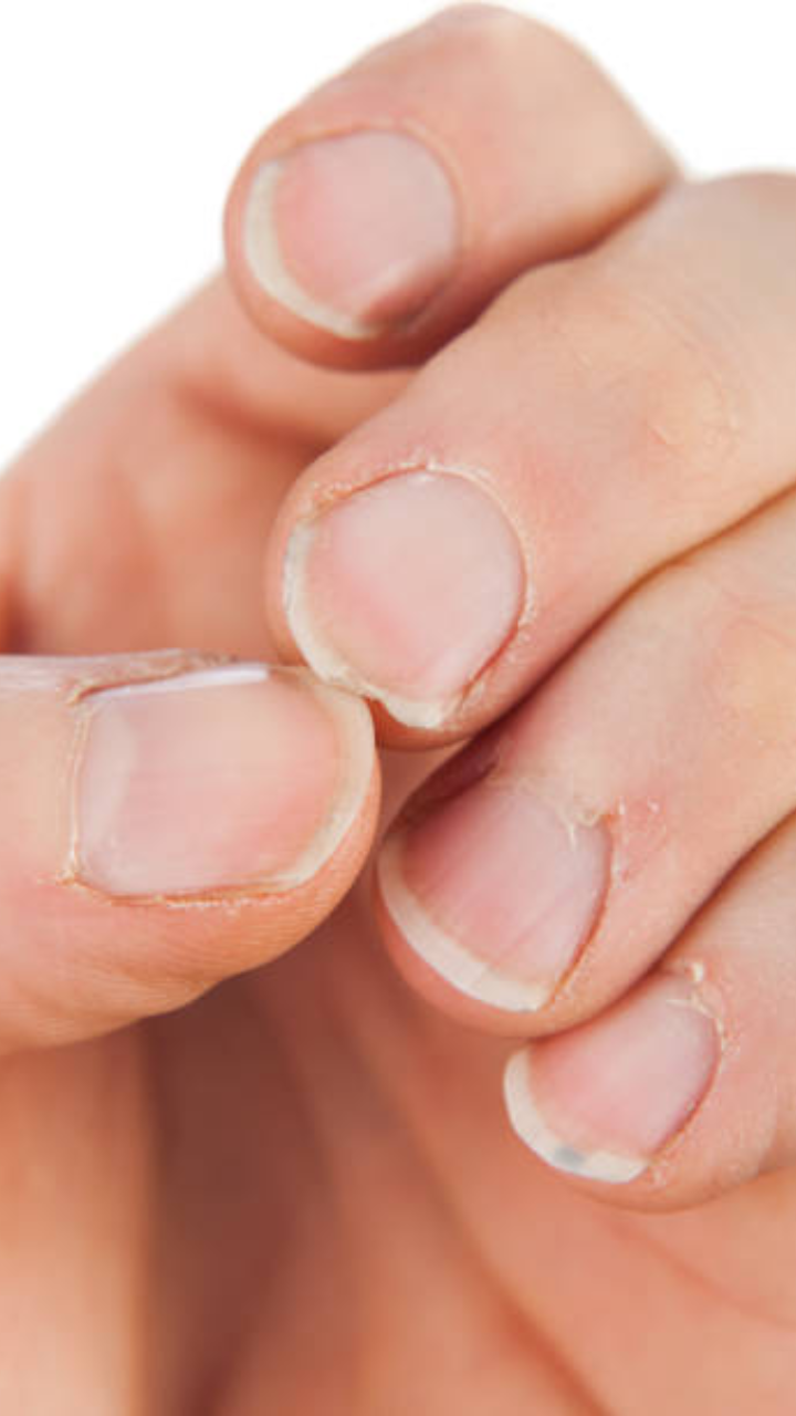 Aggregate more than 159 natural remedies for brittle nails ceg.edu.vn