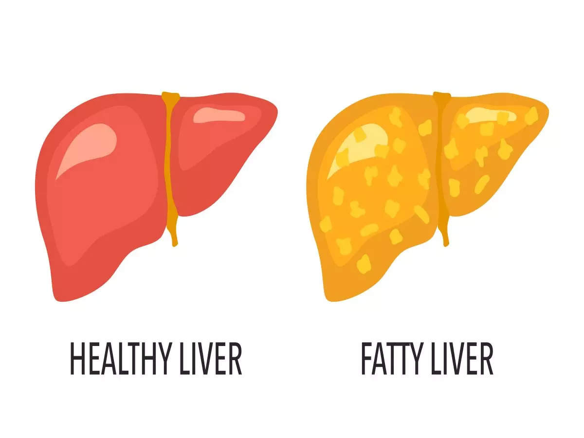 Fatty liver disease: How to identify if you have fatty liver? | The Times  of India