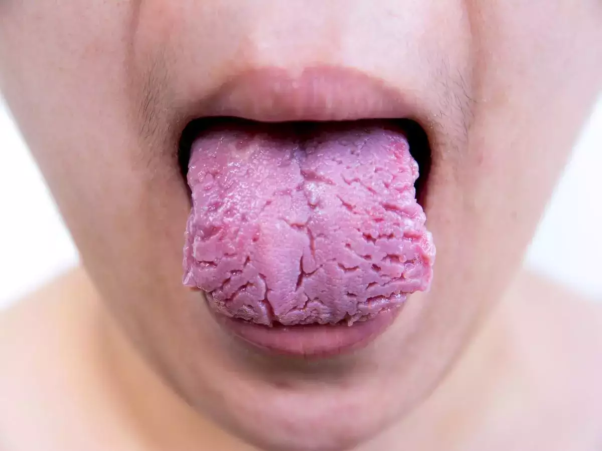 La langue scrotale ou ridée peut avertir de carences en vitamines B12 et B9