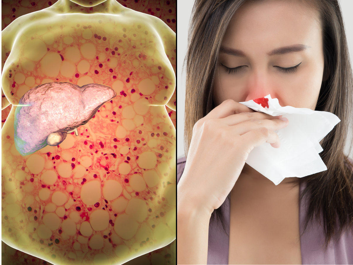 Fatty Liver Disease Symptoms Frequent Nosebleed Is A Warning Sign Of 