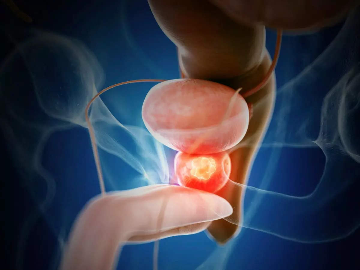 Prostate cancer: When should you start getting screened for prostate  cancer? | The Times of India