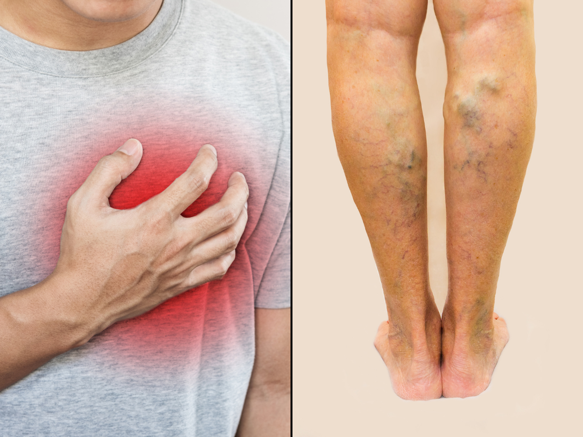 Heart Disease Symptoms Swelling In Your Lower Legs Could Be A Warning 