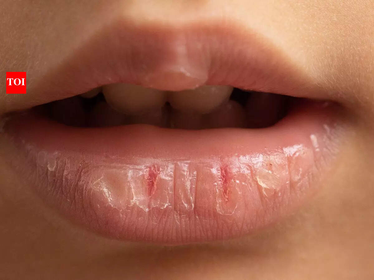 Common foods that can prevent and heal chapped lips​