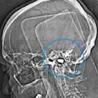 Man lives with a bullet in his brain for over 80 years