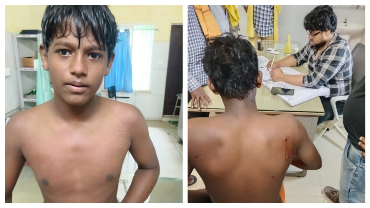Suman sustained injuries during the struggle. (Photo credit: ETV Bharat)