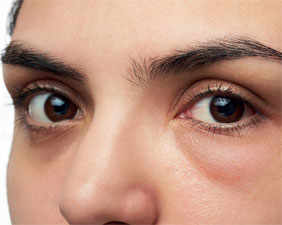 Why the puffy eyes?