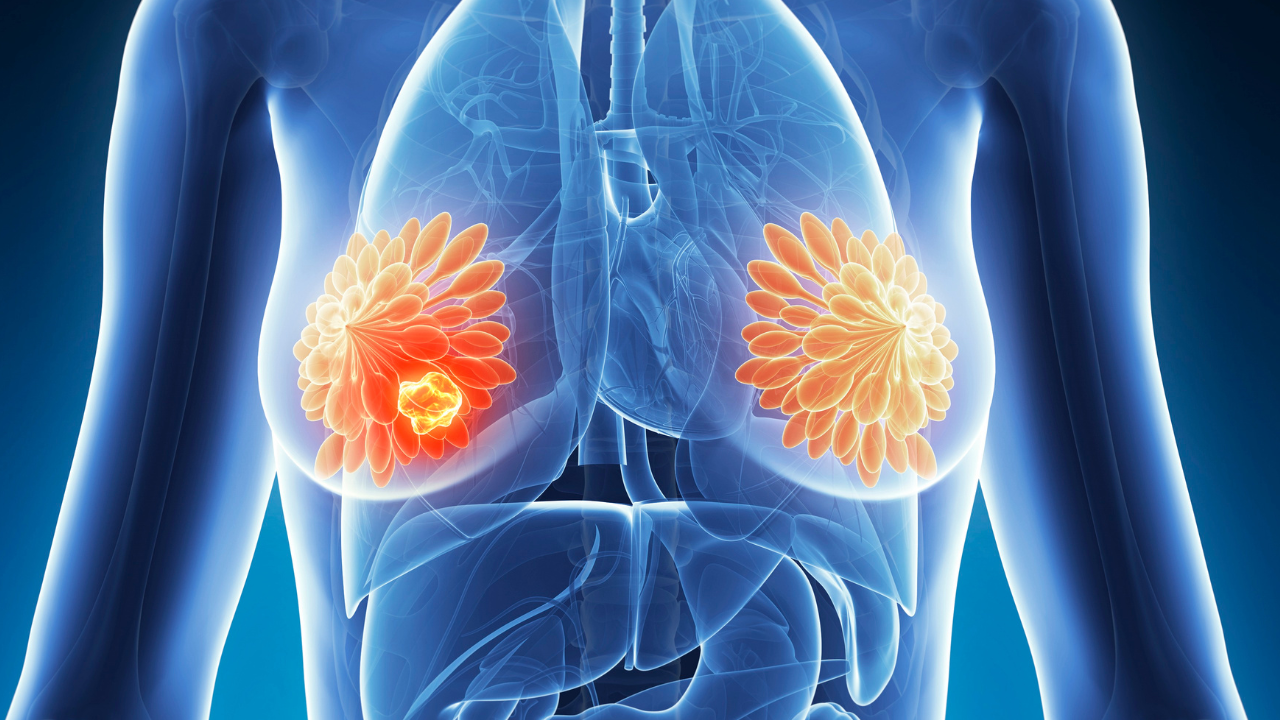 Breast Cancer: Why does breast cancer return years after initial ...