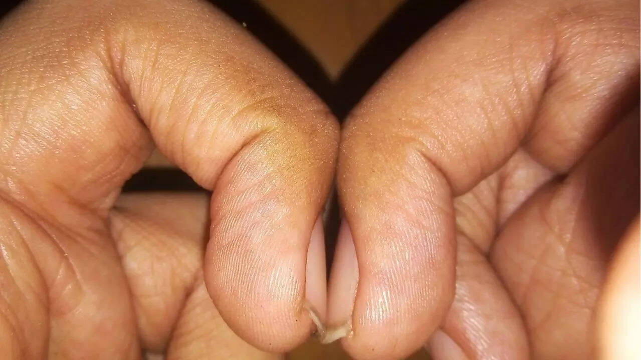 finger clubbing 1
