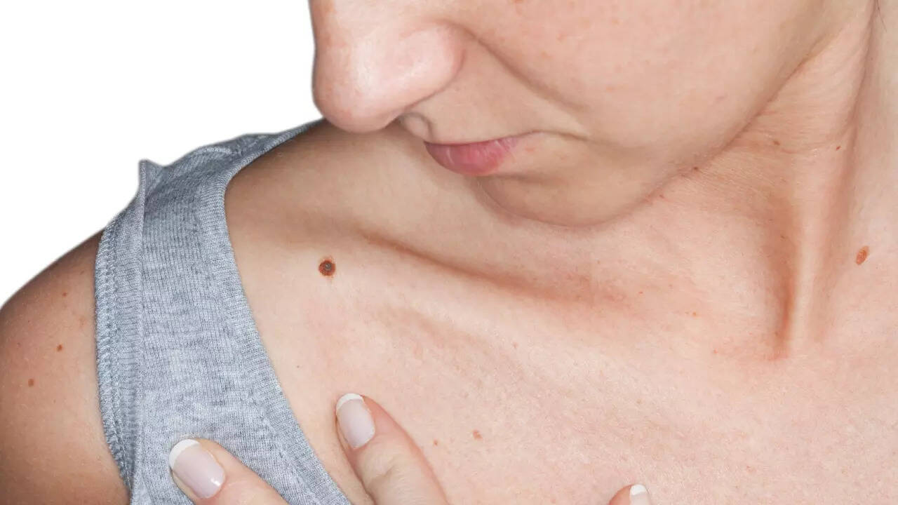 melanoma