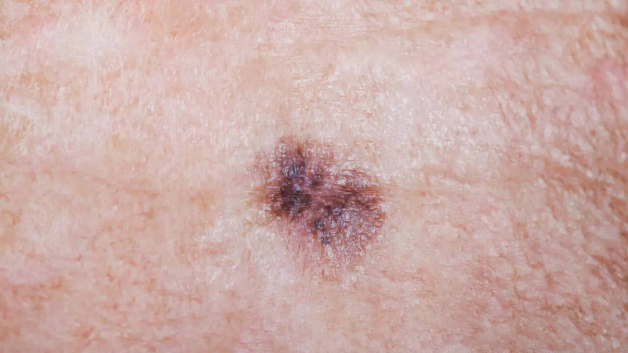 melanoma