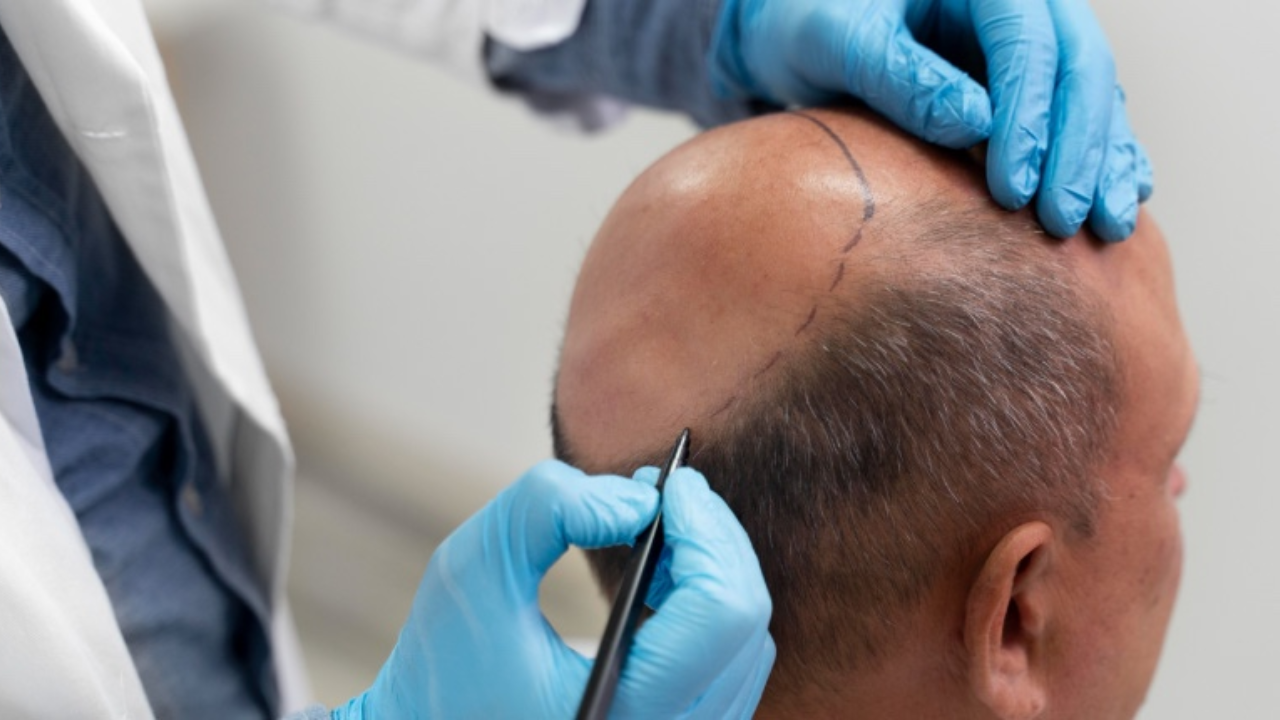 Hair transplants