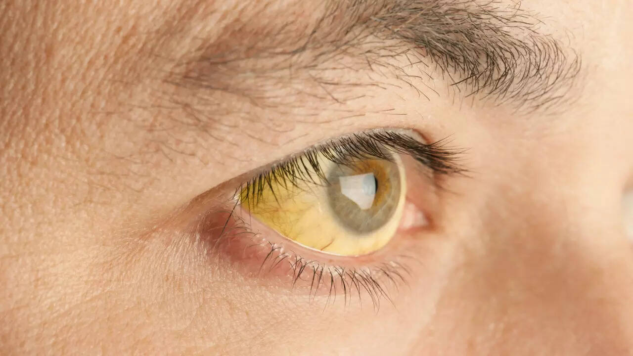 JAUNDICE