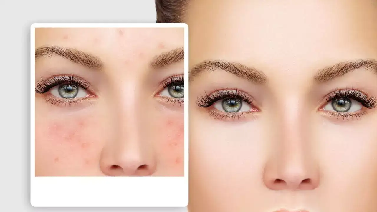 Clears acne and prevent breakouts
