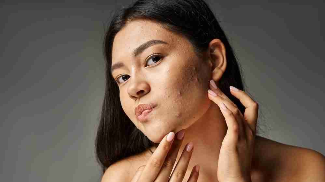 How to keep clear skin in monsoons?
