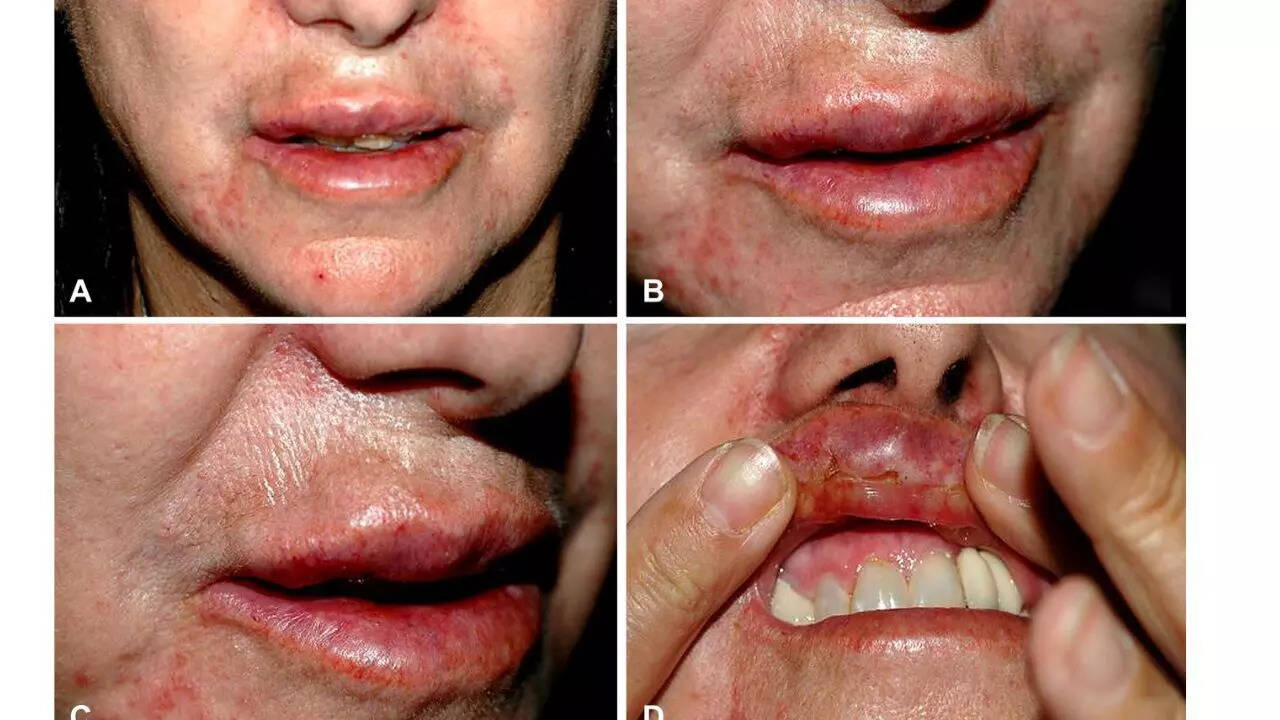 What are the risks and side effects of lip fillers