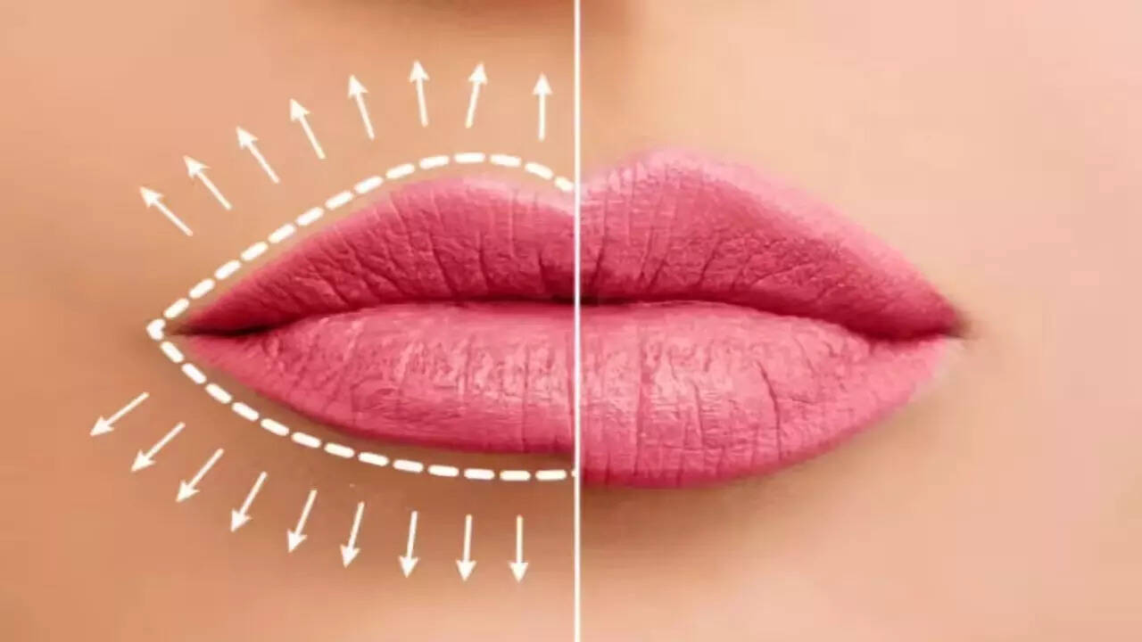What are the risks and side effects of lip fillers
