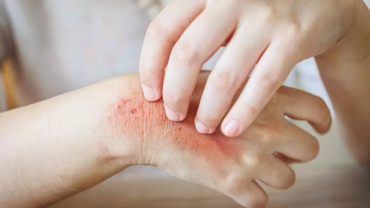 Skin Rash