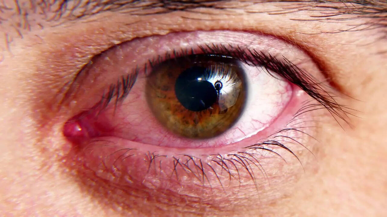 What is dry eye disease?
