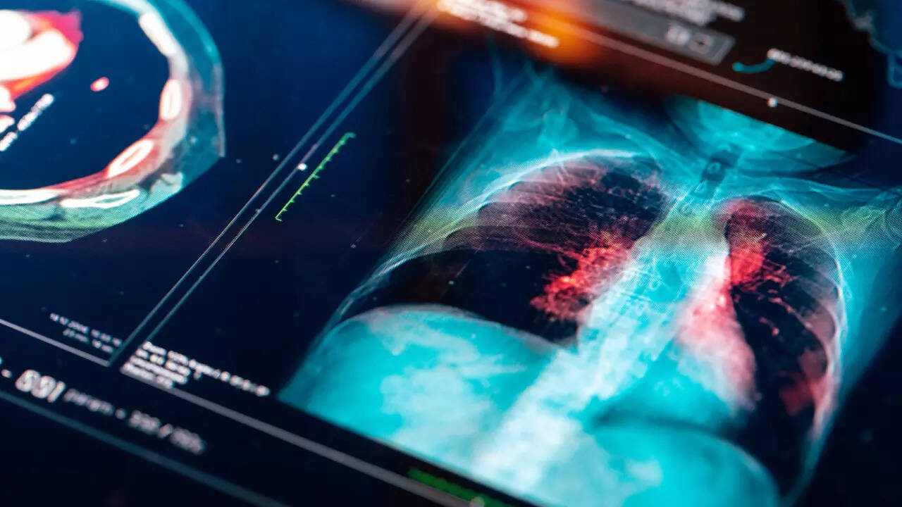 (Pic courtesy: iStock) lung cancer
