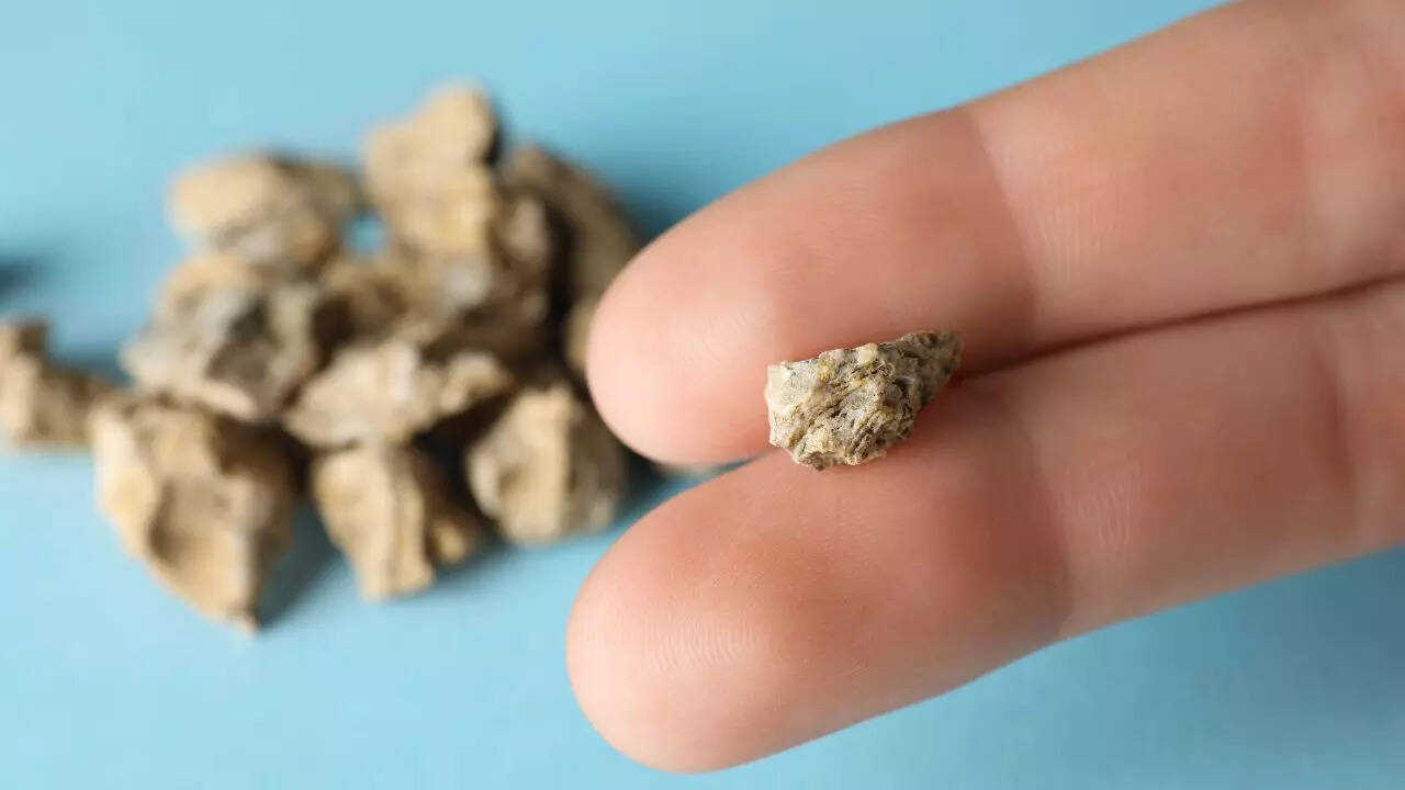 Kidney stones