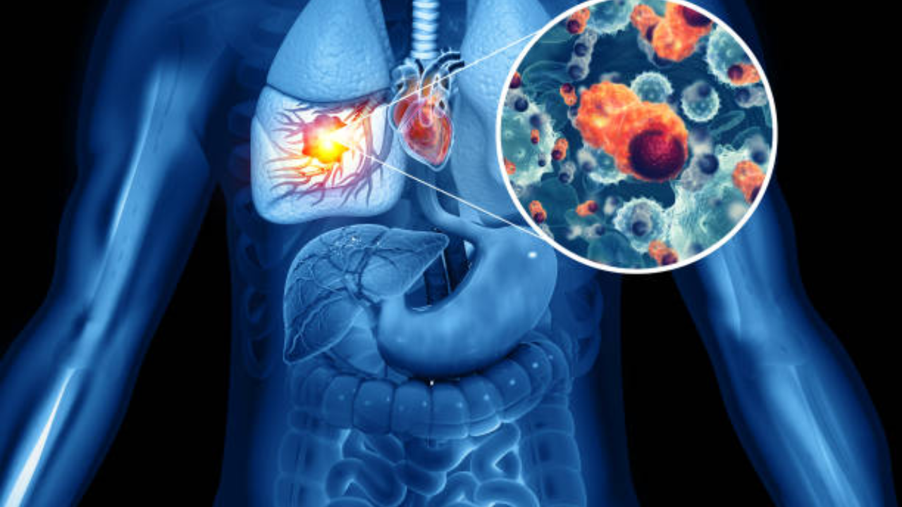 Lung cancer does not happen in youngsters / women