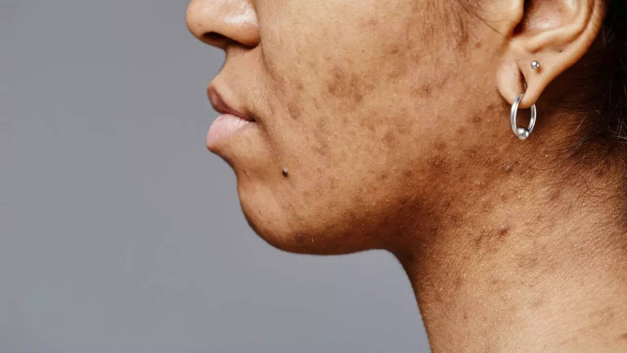 Skin pigmentation changes
