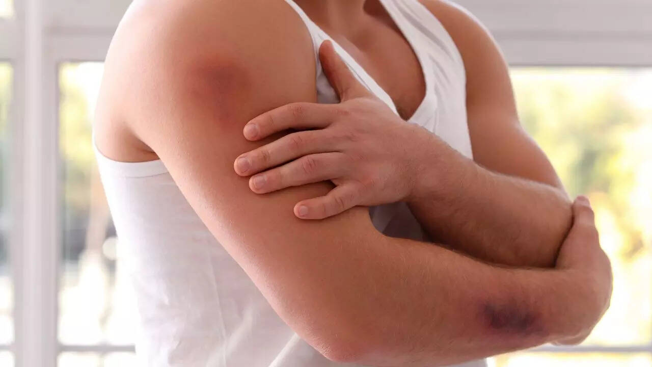 Easy bruising