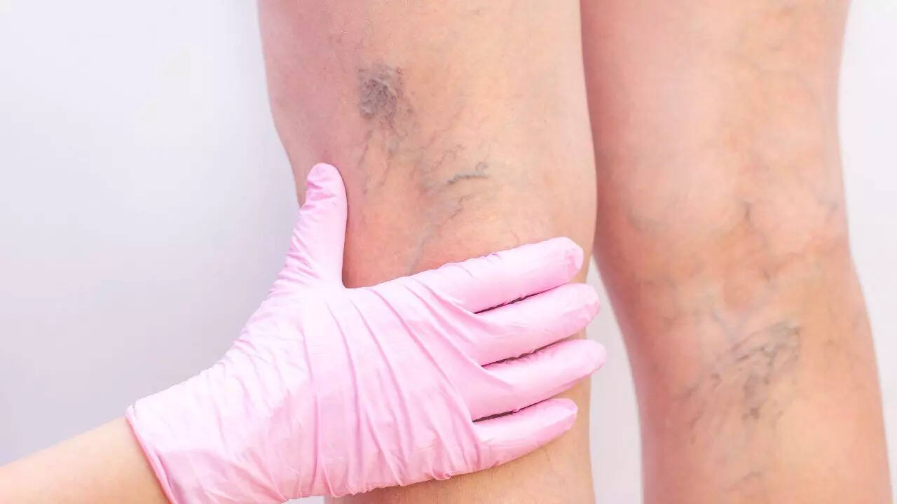 Spider veins