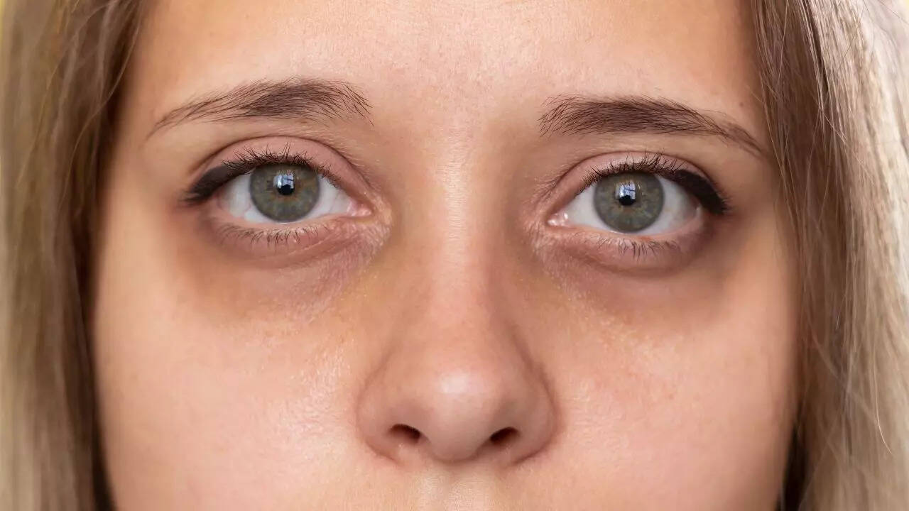 Eye changes including bulging or dryness