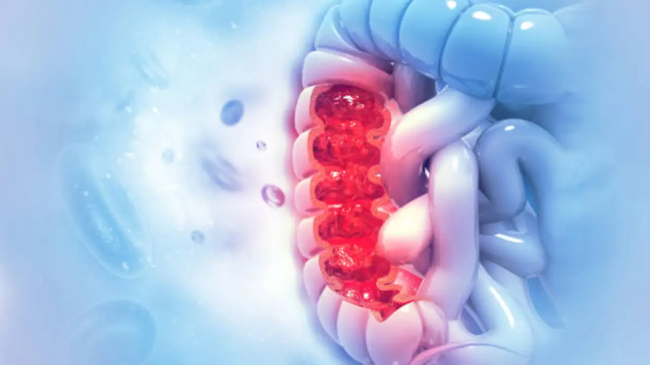 Colon cancer symptoms