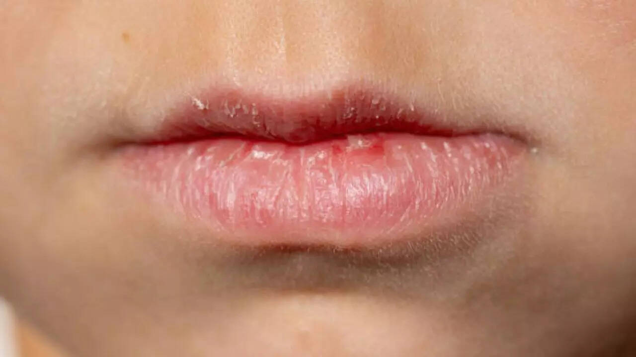 How to deal with dermatillomania?