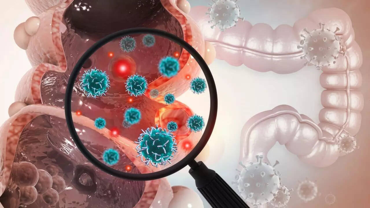 colon cancer