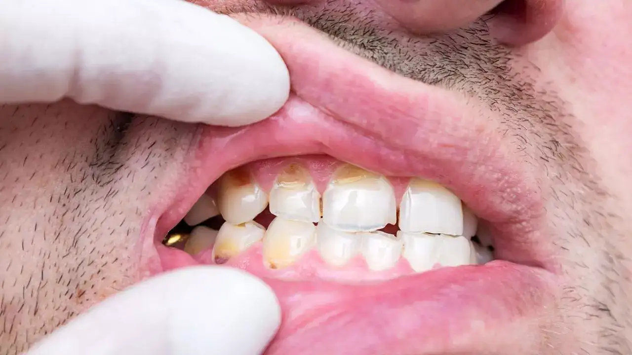 Chipped or cracked teeth: A sign of teeth grinding (Bruxism)