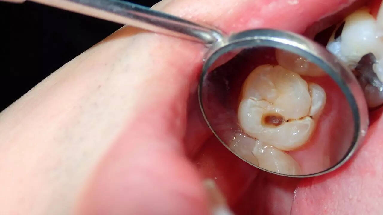 Sudden increase in cavities: Possible indicator of diabetes