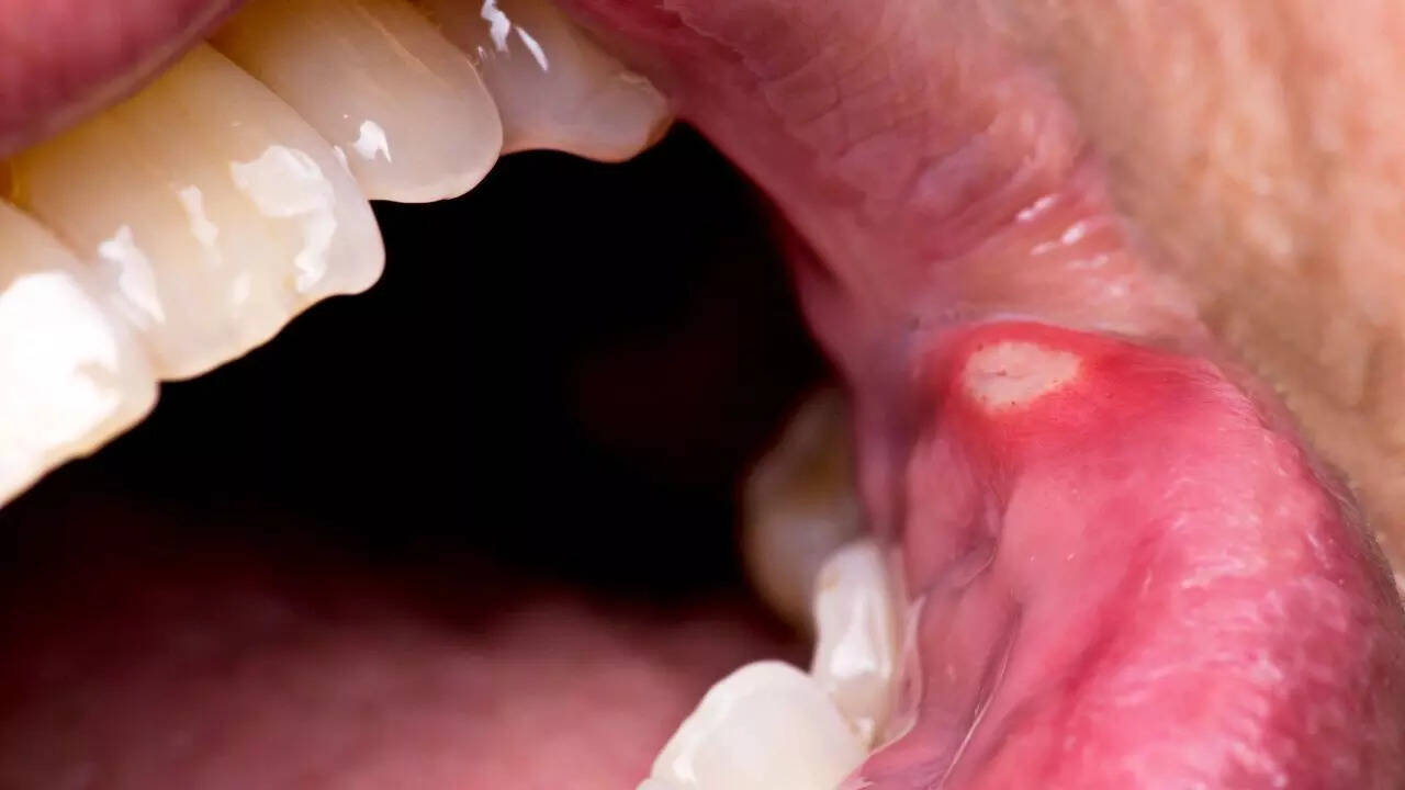 Frequent canker sores: Potential sign of celiac disease or gluten sensitivity