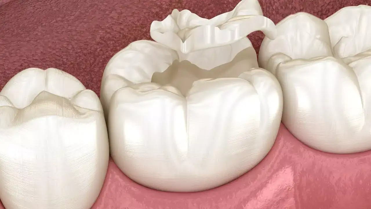Enamel wearing away: Linked to acid reflux and GERD