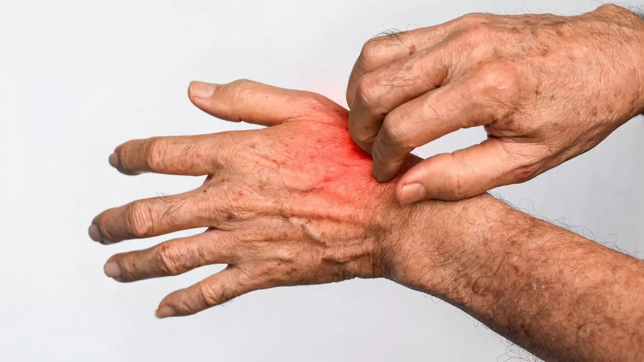 அதிகப்படியான வறண்ட சருமம் மற்றும் அரிப்பு