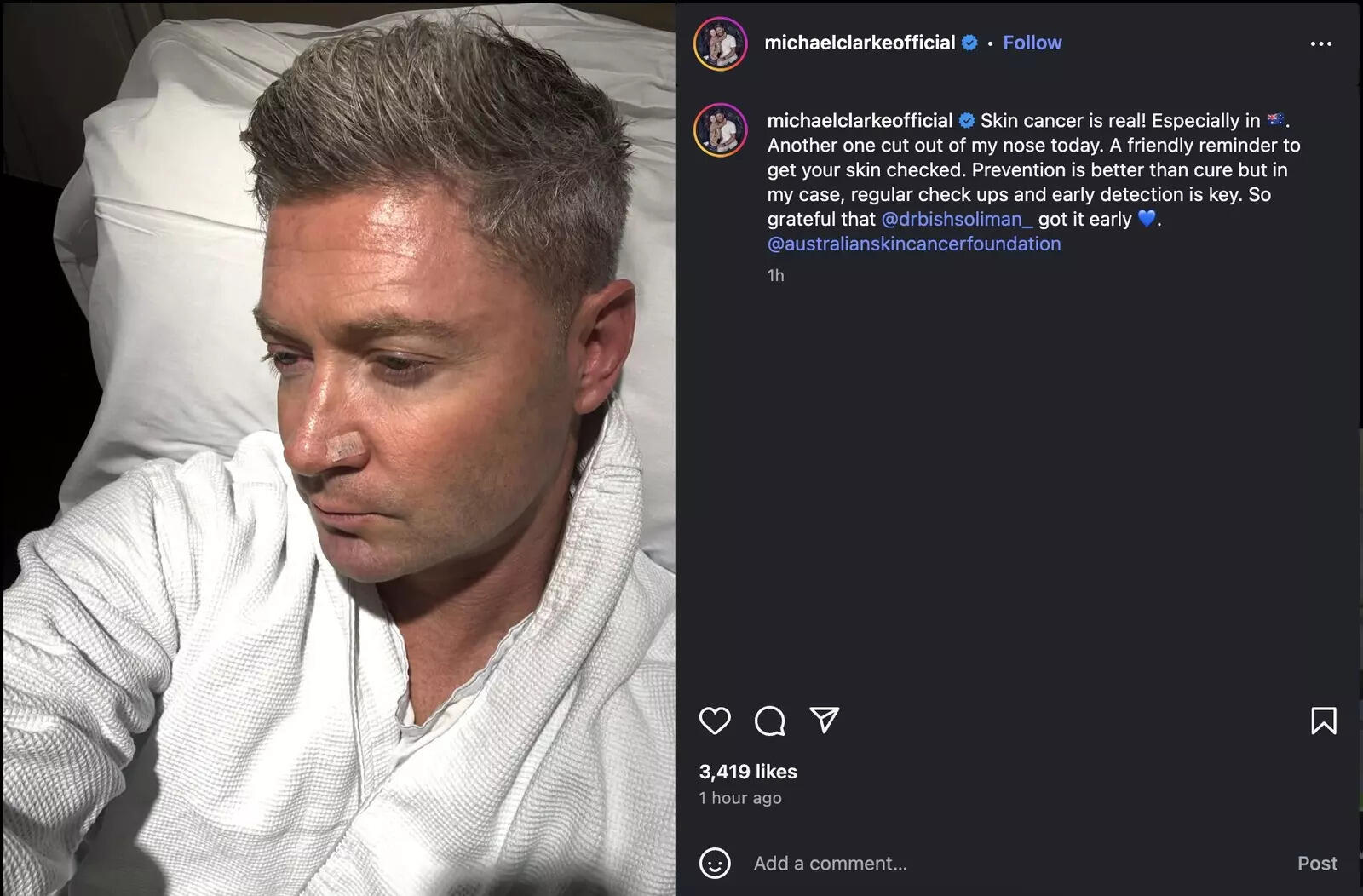Michael Clarke posted a picture after removing skin cancer from his nose. (Instagram) Michael Clarke Australia