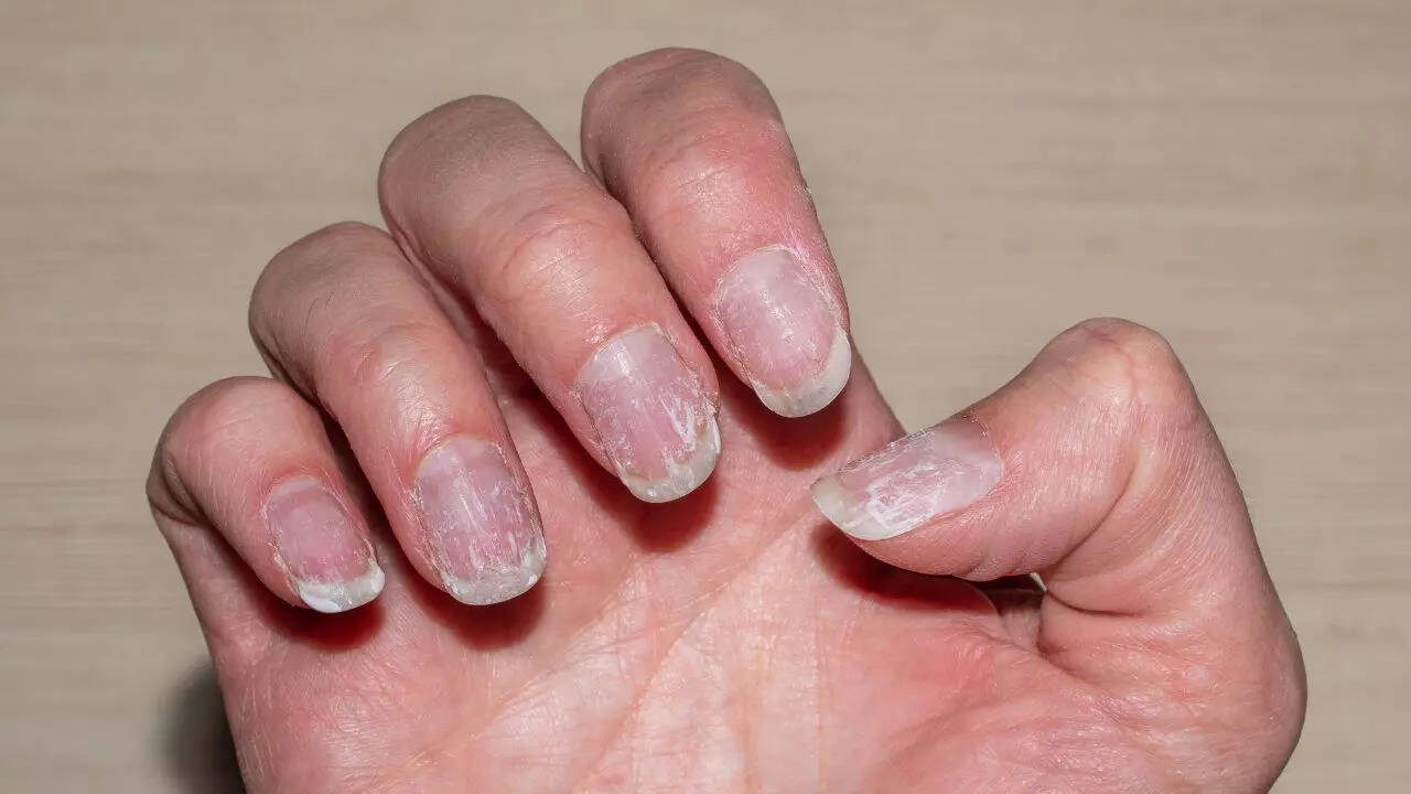 Long nails and fungal infections