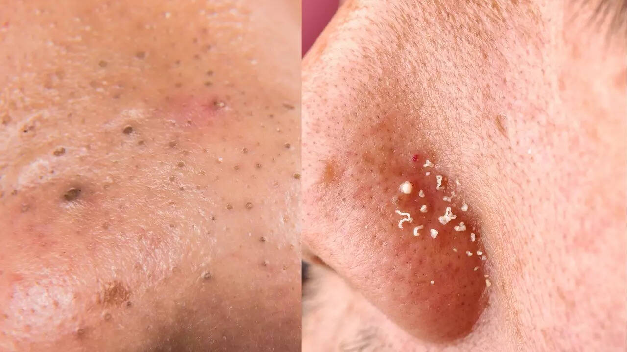 Blackheads and whiteheads differences