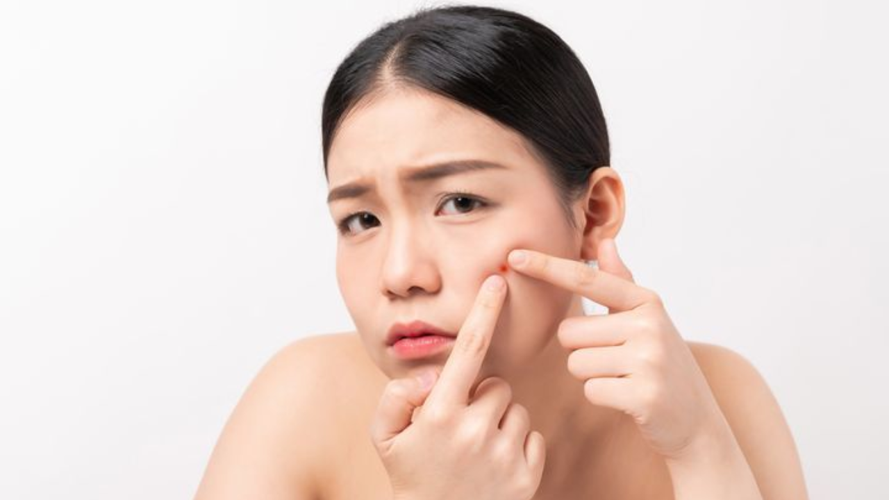 Refined oil is cooking acne, not food