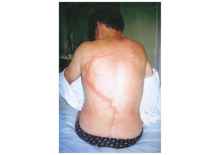 Lichtenberg figures