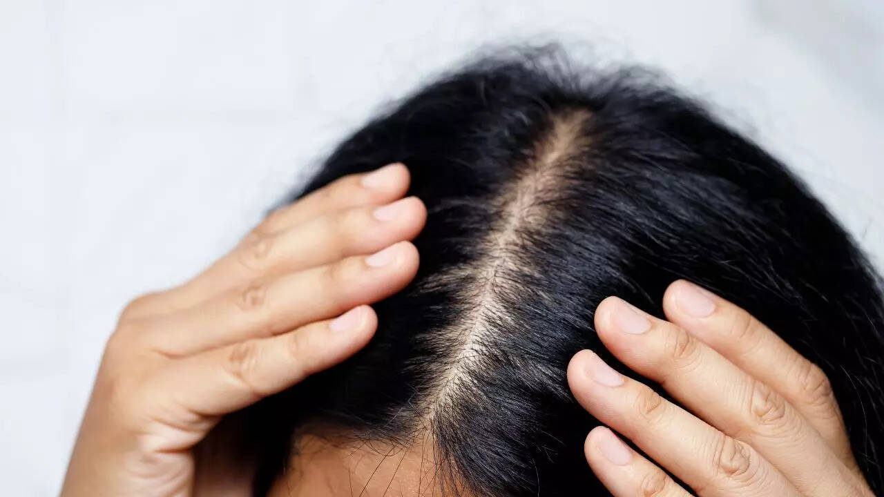 What is the PP405 hair regrowth drug and how does it work on bald spots