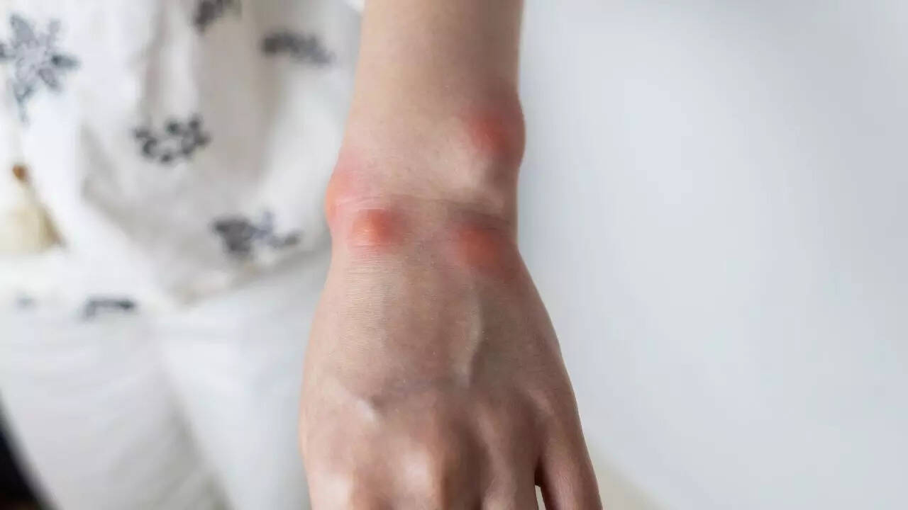 Use aloe vera or honey to soothe bee sting pain
