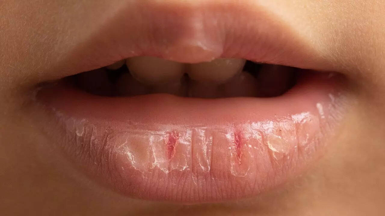Symptoms of dry lips: signs of chapped, cracked, and peeling lips