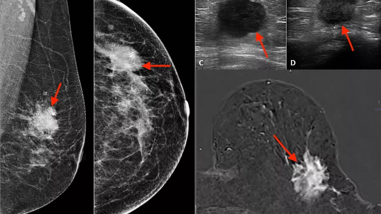 Breast cancer (21)
