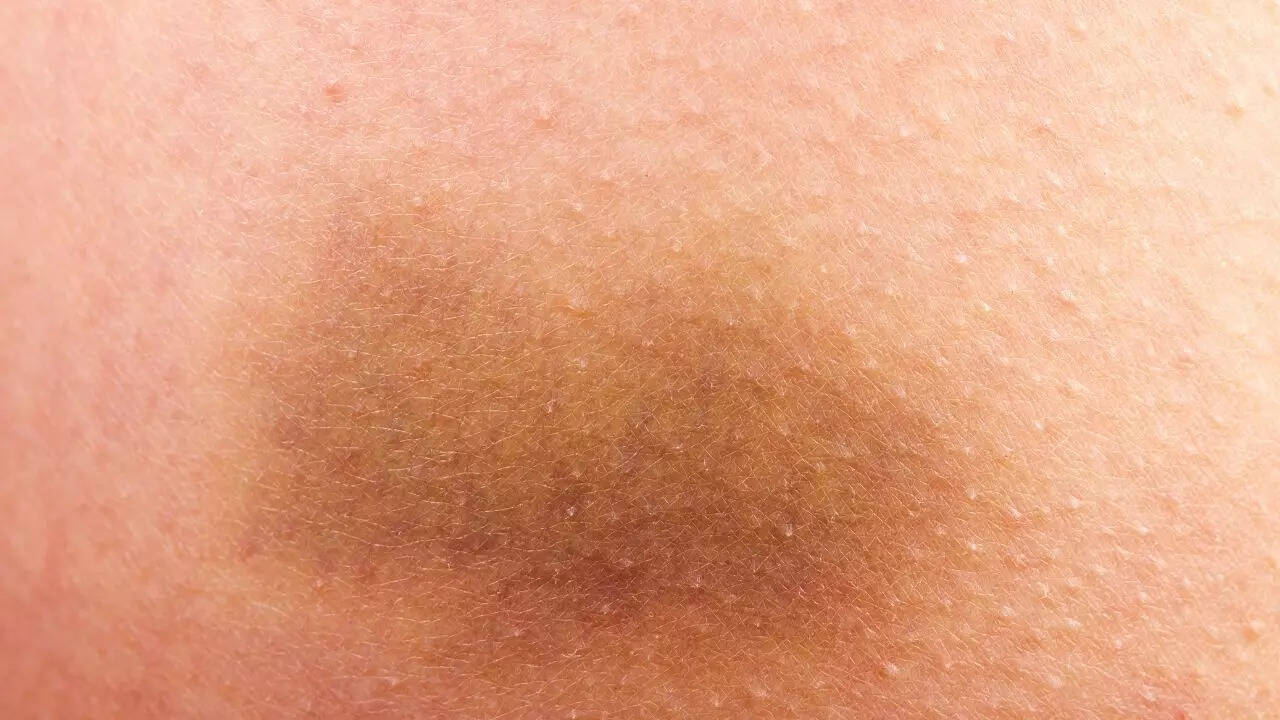 Frequent bruising may indicate a deficiency