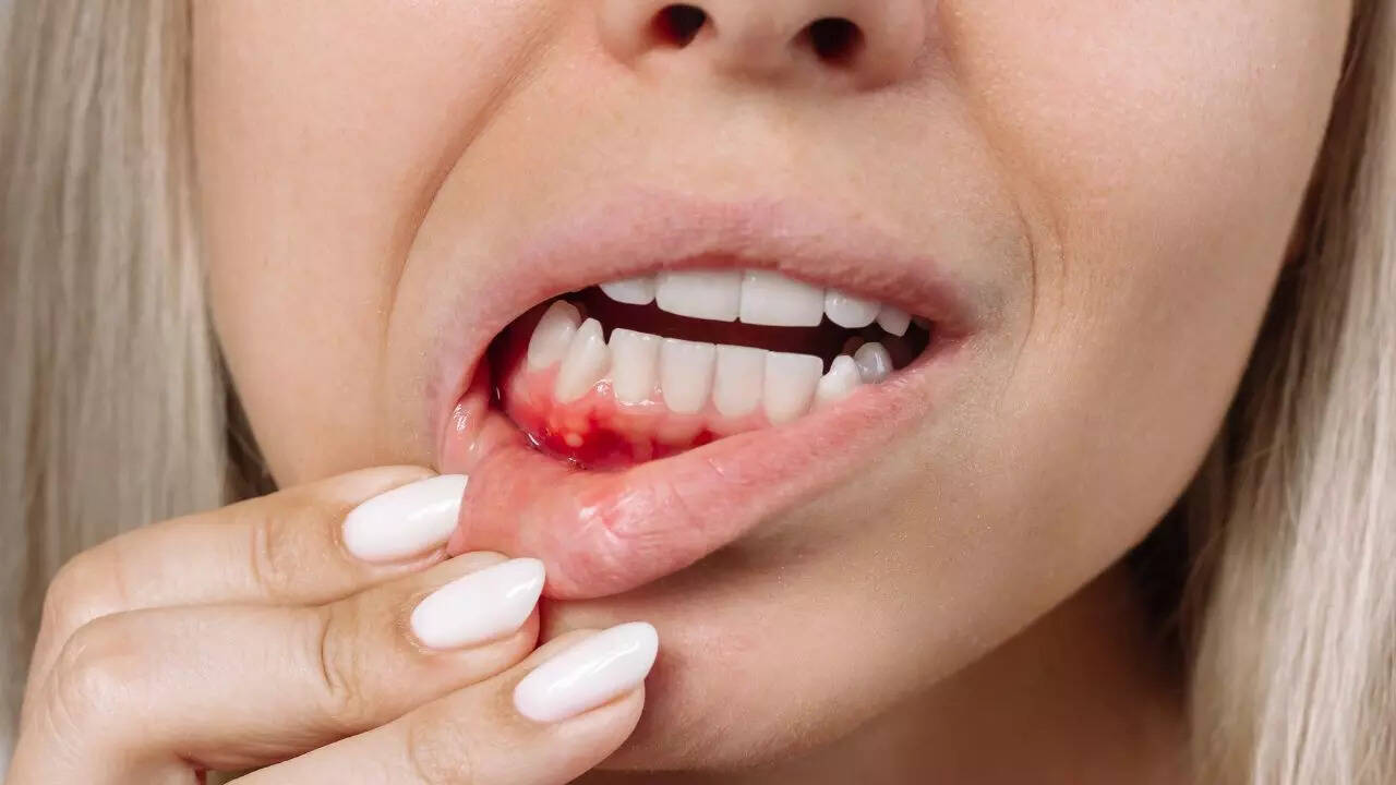 Bleeding gums may signal insufficient vitamin K